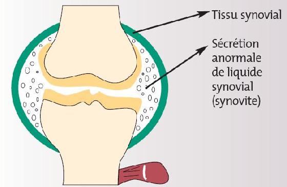 D tecter Un panchement Synovial Des Conseils d-tecter-un-panchement-synovial-des-conseils