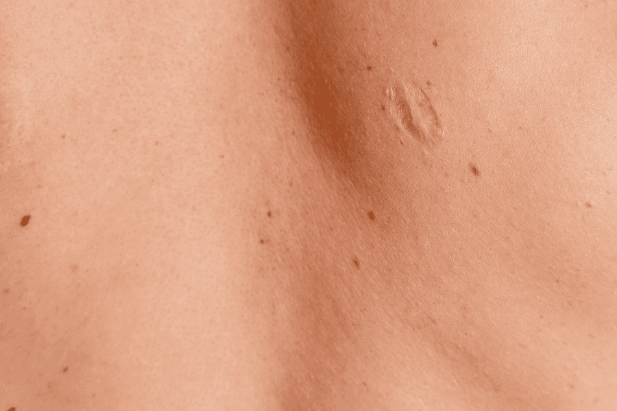 découvrez des conseils efficaces pour traiter et atténuer les cicatrices d'acné sur le dos. apprenez des méthodes de soins de la peau, des traitements professionnels ainsi que des astuces naturelles pour retrouver une peau lisse et saine.