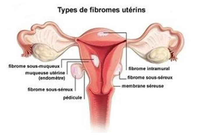 découvrez la laparotomie gynécologique, une intervention chirurgicale essentielle pour diagnostiquer et traiter diverses affections gynécologiques. apprenez-en davantage sur les indications, la procédure, et les soins post-opératoires pour assurer une récupération optimale.
