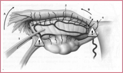 découvrez les indications médicales pour une salpingectomie ainsi que les suites opératoires à prévoir. informez-vous sur cette intervention chirurgicale et son impact sur la santé reproductive.