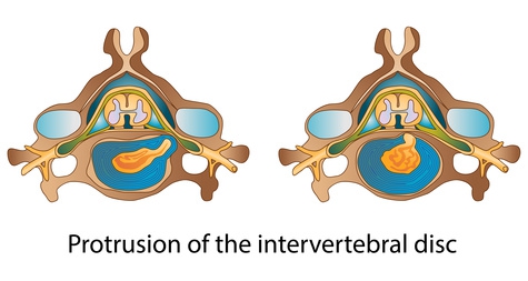 découvrez les causes, symptômes et traitements de la hernie discale cervicale. informez-vous sur cette pathologie affectant les vertèbres du cou et sur les solutions pour soulager la douleur.