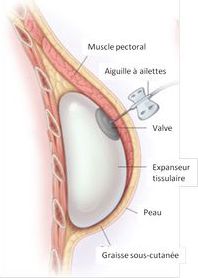 découvrez tout ce qu'il faut savoir sur la mastectomie totale : indications, déroulement de l’intervention, récupération et conséquences pour la santé, afin de mieux comprendre cette chirurgie mammaire majeure.