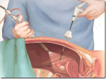 découvrez tout sur l'hystéroscopie : ses indications, comment se déroule l'examen et les conseils pour une récupération optimale.