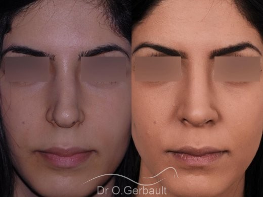 découvrez les différentes techniques de rhinoplastie trompette et obtenez des conseils pratiques pour réussir cette intervention esthétique et améliorer l'harmonie de votre visage.