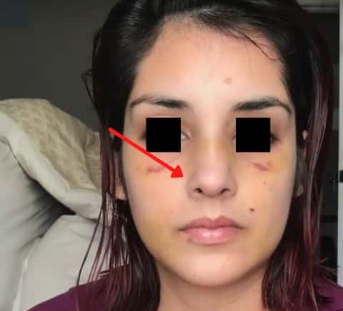 découvrez des conseils essentiels et un suivi personnalisé pour une rhinoplastie bec de corbin réussie, afin d'améliorer l'apparence et la fonction de votre nez.